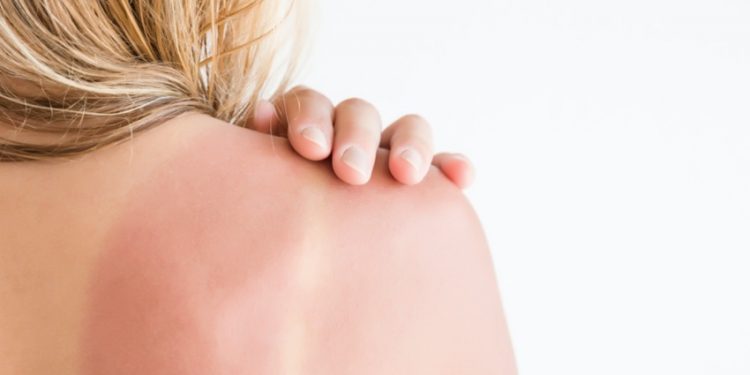 Uruguay ocupa el primer lugar en Latinoamérica en incidencia de cáncer de piel