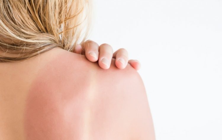 Uruguay ocupa el primer lugar en Latinoamérica en incidencia de cáncer de piel